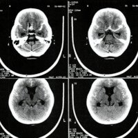 Post-Clipping Cerebrovascular Compliance in an Infant With Bilateral Anterior Circulation Aneurysms