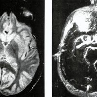 Fig. 2. A. Resonancia magnética nuclear muestra lesión temporal derecha secuelar del hematoma. B. Secuencia angiográfica en resonancia magnética no evidencia malformación vascular o alteraciones de calibre en ramas del poligono de Willis.
