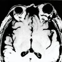 Fig. 20. IRM del mismo caso de la fig, 19 muestra iguales imágenes aunque la vena queda "enmascarada" por el brillo de la grasa (flecha),
