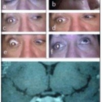 Fig. 3. a, b, c, d, e, f. Oftalmoplejía del ojo derecho de 2 meses de evolución, asociada a dolor frontoorbitario. g. IRM con contraste de encéfalo que evidencia el engrosamieno difuso del seno cavernoso.<br />

