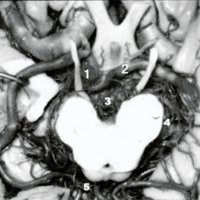 Fig. 3. Vista inferior de polígono de Willis. 1) arteria basilar (seccionada); 2) segmento P1 izquierdo; 3) arterias talamoperforantes posteriores; 4) arterias circunferenciales; 5) arteria coroidea posteromedial.