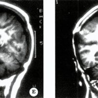 Fig. 3. E y F. IRM postoperatorias donde puede observarse la imagen hipodensa sin efecto de masa del área residual del tumor.