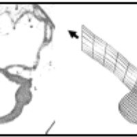 Fig. 6. Angiografía y esquema del vaso con su aneurisma en la simulación computarizada del flujo del caso de Moret y col.60. en la angiografía, la punta de flecha indica el aneurisma y la flechas la rama colateral de la a. cerebral media. En el esquema, las flechas indican la dirección del flujo.