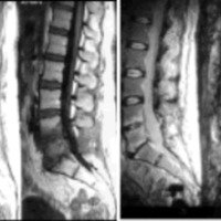 Fig. 2. Imagen 4 semanas postoperatorio. Compromiso osteomielítico L4 L5 y S1.