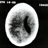 Figura 4. Imagen sin contraste en la que se ve sólo el edema.
