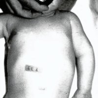 Fig. 2. Parálisis total del plexo braquial, 6 meses de edad.