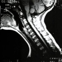 Fig. 2. IRM. Corte sagital en T1 donde se aprecia lesión isointensa a nivel de la unión craneovertebral.