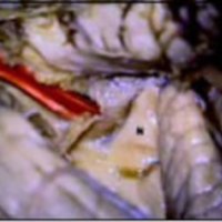 Fig. 12. Se ha introducido un catéter rojo desde el agujero de Luschka, en el receso lateral; lr: labio rómbico. T cho: tela coroidea. CR: cuerpo restiforme. Vmi: velo medular inferior I.: zona de inserción de la amígdala. A la derecha, dos pasos en la apertura y resección de la tela coroidea. N: cara inferior del nódulo.
