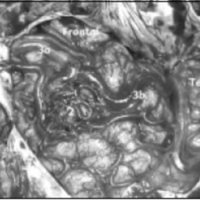 Fig. 2. Foto intraoperatoria de la MAV de la figura 1. Se visualiza el nido (2) y los drenajes 3a al seno y 3b a las venas silvianas. Las arterias son más profundas y hay que buscarlas dentro de los surcos. El aneurisma ya ha sido clipado.