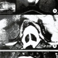 Figs. 9. TC en tres casos de Diastematomielia. Se aprecia la división del canal espinal por un tabique óseo.