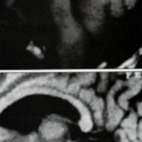 Fig. 2. Astrocitoma grado II de bulbo raquídeo; A) RNM prequirúrgica; B) RNM postquirúrgica.
