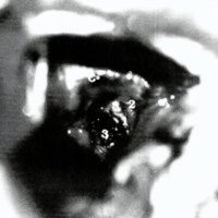Fig. 5. Imagen intraoperatoria luego de la resección de la MAV. El área coagulada corresponde al lecho quirúrgico en el tálamo (3), con la fimbria (1) y el cuerpo calloso (2) por detrás. C: cíngulo