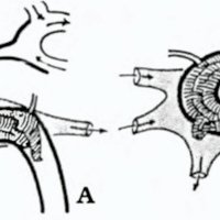 Fig 6. Esquema en vista lateral izquierda de la operación de Hamby según este mismo autor, 