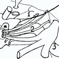 Figura 18: Vías de abordaje al seno cavernoso. Esquema redibujado de Sekhar (28) levemente modificado. 1) Vía superior: 2) Vía lateral: 3) Vía inferior. 