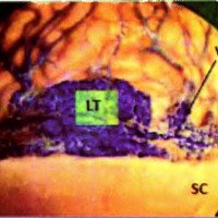 Fig .15. Disección anatómica donde se evidencia comunicación de venas puente (VP) y lagunas laterales (LT) en el tercio medio del seno sagita! superior (SSS) en relación con la sutura coronal, (SC).