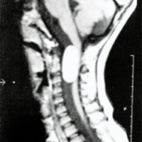 Fig. 2. IRM que muestra una lesión hiperintensa en T1 intradural extramedular