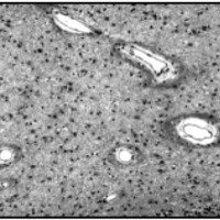 Fig. 1. (Masson x 250) Cerebro. Región Temporal. Proliferación reactiva de astrocitos (astrogliosis), los cuales producen un reforzamiento de la trama fibrilar perivascular observada en una Esclerosis Mesial