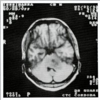 Figura 1. Paciente de 18 años con Astrocitoma Fibrilar G 11 de protuberancia con invasión de pedúnculo cerebeloso medio izquierdo.