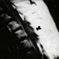 Fig. 1: Corte sagital de imágenes ponderadas en T1 que muestran el tumor isointenso y la banda hipointensa que lo separa de la médula espinal.