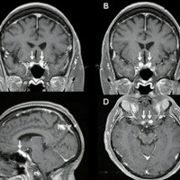 Figura 4: RMN con contraste, secuencia T1. A y B cortes coronales, C corte parasagital, D corte axial. Se ve un meningioma foraminal bilateral que compromete y engloba ambos nervios ópticos. El tumor se señala con una flecha blanca.