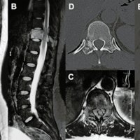 Utilidad de la cirugía espinal mínimamente invasiva (MISS) en el manejo de las metástasis espinales toraco-lumbares