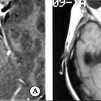 Fig. 1. Paciente sexo femenino 24 años de edad. A. RM corte axial T1 con contraste evidenciando lesión protuberencial derecha. B. Control postoperatorio sin lesión residual.