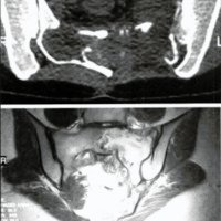 Fig. 3. TAC y IRM: recidiva tumoral. Nótese la osteólisis y el compromiso de la articulación sacroilíaca