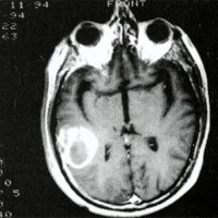 Fig. 7. Caso 7, IRM con contraste T1