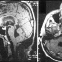 Fig. 2. IRM postoperatoria realizada a los 120 días. A. IRM sagita! en TI con contraste: se observa la e'xéresis completa de la lesión. B. IRM axial en T¡ con gadolinio.