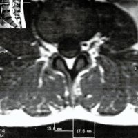 Ubicación del Hiato entre los Músculos Sacroespinales Longissimus y Multifidus en Imágenes por Resonancia Magnética