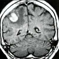 Fig. 3. RMI corte coronal TI con gadolinio (caso 4)