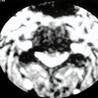 Fig. 4. TAC: osteofitosis medial retrocorporal