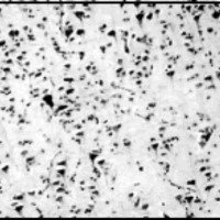 Fig. 2. (H-E x 250) Cerebro. Pérdida de la laminación horizontal por desorganización de las capas corticales, hallándose neuronas piramidales de gran tamaño en diversos estratos. Trastorno de la Migración Neuronal. Displasia Cortical.-