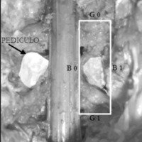 Fig. 2. Preparado cadavérico que evidencia la extirpación de los pedículos y la aparición del rectángulo de G0 G1 B0 B1.