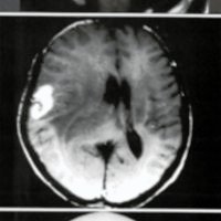 Fig. 1. Glioblastoma multicéntrico. A) RNM prequirúrgico que muestra ubicación occipital derecho; B) RNM prequirúrgica que evidencia localización paretal derecha; C) TC postquirúrgica, 8 meses de operado.<br />
