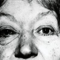Fig. 2. Fístula dural cavernosa (FDC) de bajo flujo. Obsérvese ligero edema palpebral e inyección conjuntival en ojo derecho.
