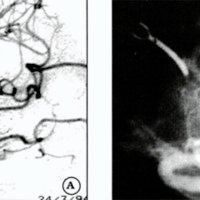 Fig. 5. A. Aneurisma distal, tratado mediante parking. Postoperatorio. B. aneurisma postclipado: clip alejado del cuello, en función de la estenosis arterial observada en perioperatorio.