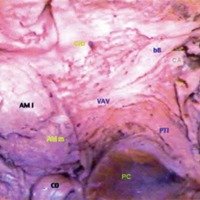 Fig. 10. Disección de un hemisferio derecho para mostrar las fibras de la vía amigdalófuga ventral. 