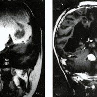 Fig. 4. Meningioma que ocupaba la totalidad del sistema ventricular. A: prequirúrgico. B: postquirúrgico (exéresis total del componente supratentorial con persistencia de meningioma del cuarto ventrículo asintomático)<br />
