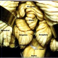 Fig. 3. Relacion del cuarto ventriculo con las amigdalas y lobulos biventrales.