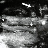 Fig. 5. En esta figura se observa el nacimiento de la arteria oftálmica, (en azul), su relación con el nervio óptico, nervios oculomotores y el V par.