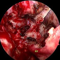 Figura 22: Rostrum esfenoidal tras la septectomía posterior. Se aprecia un Flap de rescate (RF).