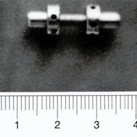 Figura 4. Foto de la prótesis metálica (distractor-estabilizador).