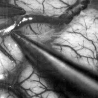 Fig. 1. Photomicrographillustrating opening of the arachnoid over a cortical vessel using fine forceps.