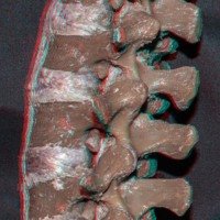 Figura 3: Vista lateral izquierda del modelo cadavérico. Se observa la relación estrecha entre la raíz nerviosa en el neuroforamen con la pars interarticularis, por detrás y arriba, y la faceta ascendente, por detrás y abajo.