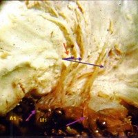 Fig. 8. Trayecto intraparenquimatoso de los vasos lenticuloes triados en un hemisferio izquierdo (inyección con gelatina).