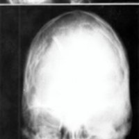 Fig. 1. Control radiológico de paciente operado de hidrocefalia en el período neonatal. Se observa marcado engrosamiento de la calota craneana, craneosinostosis secundaria y perímetro cefálico bajo.