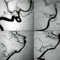 Fig. 2. Angiografia digital, pre y postquirúrgica de clipado de aneurisma vertebro- PICA derecho.