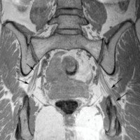 Figura 2: Nervio ciático normal. Secuencia IDEAL T1. Se observa el patrón fascicular de ambos nervios ciáticos (flechas). 