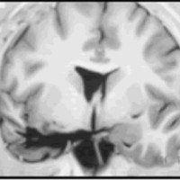 Fig. 26. Las tres imágenes postoperatorias coronales IR muestran una AHS a través de T2.